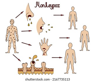 The Mechanism Of Transmission Of Monkeypox. Diagram Of Human-to-human Transmission Of The Smallpox Virus. Color Vector Illustration. Transmission Through Body Fluids, Skin Injury. Viral Disease. 