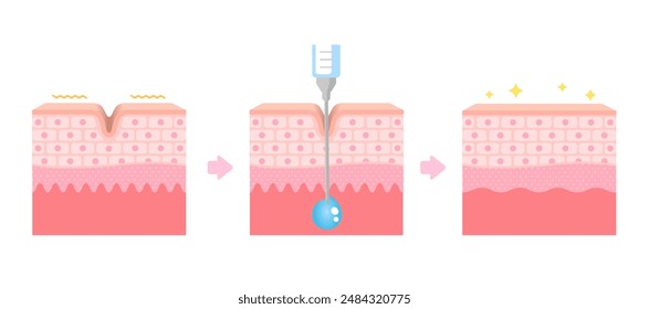 Mechanism of wrinkle improvement with botulinum toxin injection