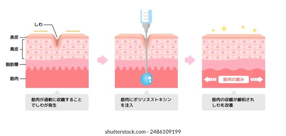 Mechanism of wrinkle improvement with botulinum toxin injection. Translation: Epidermis, Dermis, Fat, Muscle, Botulinum toxin, Relax muscles, Wrinkles occur due to excessive muscle contraction etc.