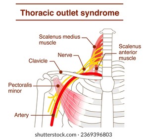 Mechanisms and Causes of Thoracic Outlet Syndrome - Shutterstock ID 2369396803