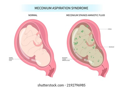 Meconium aspiration syndrome in fetal care and womb Hirschsprung's