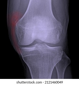 Medial collateral ligament avulsion fracture stieda fracture radiology bone x ray 