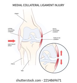 Medial collateral ligament Injury with athletic pop meniscal femur Grade or hurt test