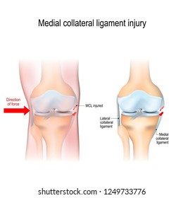 Mediale Verletzungen des Knies. Gelenkanatomie. Vektorgrafik für biologische, medizinische, wissenschaftliche und erzieherische Zwecke