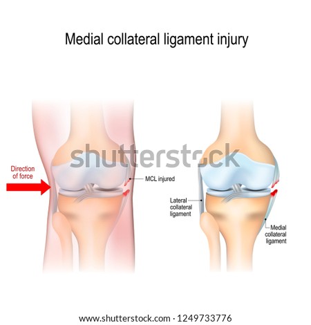 Medial Knee Injuries Joint Anatomy Vector Stock Vektorgrafik