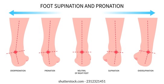 medial tibial stress syndrome knee toe or Pronation supination inward roll Feet over and Achilles Lower high fallen laxity Obesity hollow excessive of Patellofemoral tendon ligament athletes sport