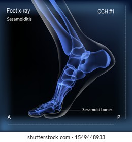 Medial view x ray of bones the of foot with sesamoid.