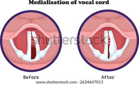 Medialization and lateralization of the vocal cord are surgical procedures used to correct vocal cord paralysis or voice disorders
