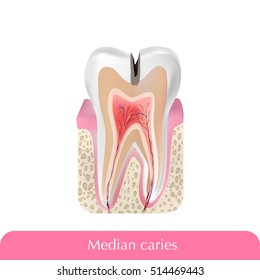 Median caries with title. Vector illustration.