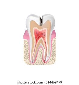 Median caries. Vector illustration.