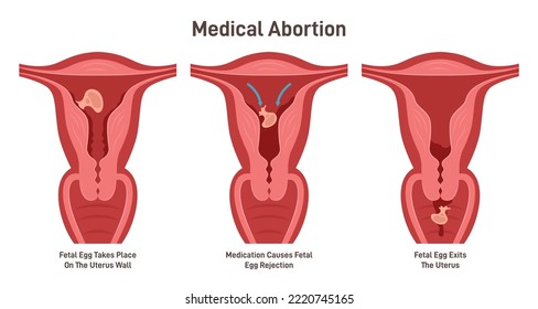 Medical Abortion Procedure. Medications Used For Abortion. Fetal Egg Rejection And Exit. Flat Vector Illustration