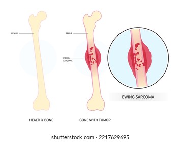 Medical anatomy leg bone pain of The Ewing's sarcoma tumor cell with hip femur gross and soft tissues gene mutation chromosomal inflammation of chondrosarcoma by needle transplant