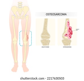 Medical anatomy leg bone pain of The Ewing's sarcoma tumor cell with hip femur gross and soft tissues gene mutation chromosomal inflammation of chondrosarcoma by needle transplant