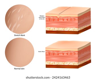 Marcas de estiramiento de la piel de la anatomía médica. Collagen elastin. Marca normal de piel y estiramiento 