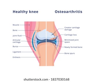 Medizinischer Banner des Unterschieds zwischen gesundem Gelenk und geschädigt mit Osteoarthritis, flache Vektorgrafik auf weißem Hintergrund. Osteoarthritis Degeneration der Gelenke.