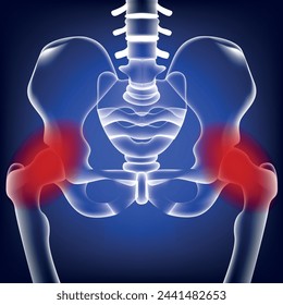Medical, blue, neon background with human pelvic bones. Osteoporosis. Medical poster