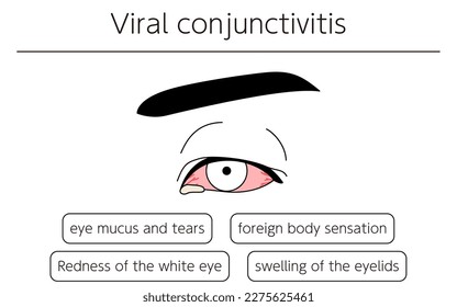 Medical Clipart, Line Drawing Illustration of Eye Disease and Viral conjunctivitis, Vector Illustration