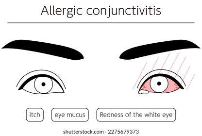 Medical Clipart, Line Drawing Illustration of Eye Disease and Allergic conjunctivitis, Vector Illustration