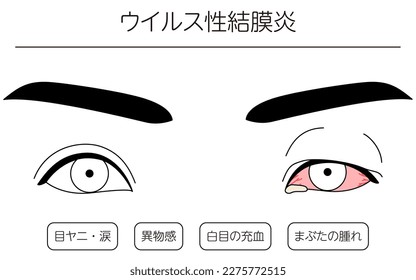 Medical Clipart, Line Drawing Illustration of Eye Disease and Viral conjunctivitis - Translation: Viral conjunctivitis, eye mucus and tears, foreign body sensation, Redness of the white eye, swelling 