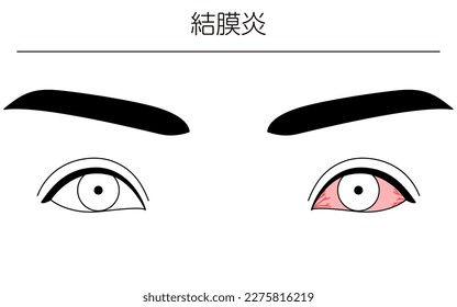 Medical Clipart, Line Drawing Illustration of Eye Disease and Conjunctivitis - Translation: Conjunctivitis