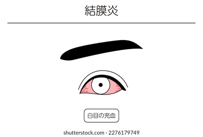 Medical Clipart, Line Drawing Illustration of Eye Disease and Conjunctivitis - Translation: Conjunctivitis