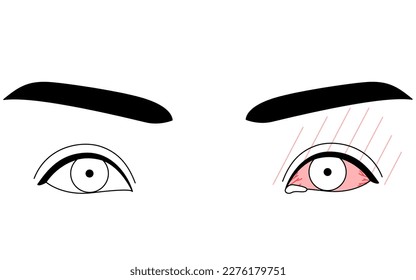 Medical Clipart, Line Drawing Illustration of Eye Disease and Allergic conjunctivitis, Vector Illustration