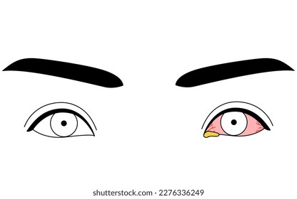 Medical Clipart, Line Drawing Illustration of Eye Disease and Bacterial conjunctivitis, Vector Illustration
