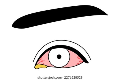 Medical Clipart, Line Drawing Illustration of Eye Disease and Bacterial conjunctivitis, Vector Illustration