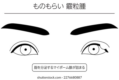 Medical Clipart, Line Drawing Illustration of Eye Disease and Sty, chalazia - Translation: Sty, chalazia, Clogged meibomian glands that secrete oil