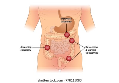 medical colostomy vector