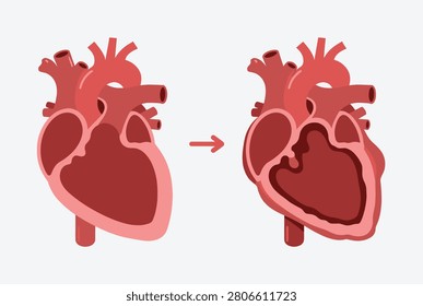 Medical comparison of a normal human heart and one with left ventricular hypertrophy indicated by a thickened muscular wall.
