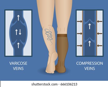 Medical Compression Socks For The Treatment Of Varicose Veins. Medical Hosiery.