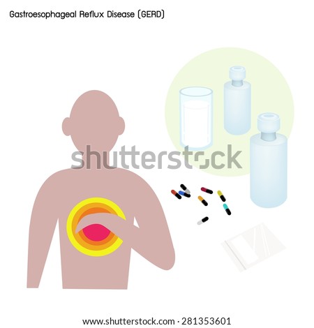 Medical Concept, Illustration of Heartburn and Gastroesophageal Reflux Disease or GERD Caused by Stomach Acid Coming Up From The Stomach into The Esophagus. 
