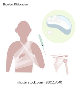 Medical Concept, Illustration of Shoulder Dislocation Caused by Sports Accident or Arthritis as A Skeletal Joint Problem.