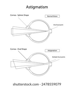 Medical design astigmatism disease with line illustration