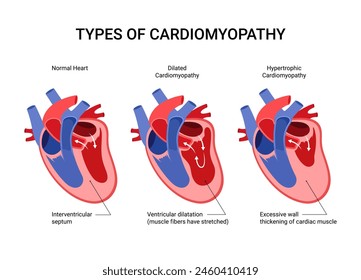 Medical design diagram for types cardiomyopathies