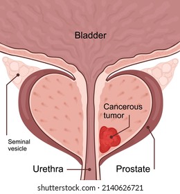 Medical diagram of 1 stage of prostate cancer. tumor grows and penetrates into neighboring organs and tissues.  small tumor vector illustration. 