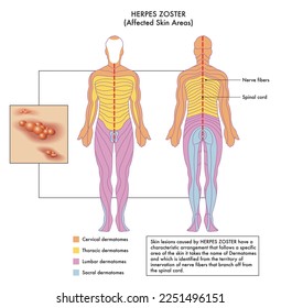 Medizinisches Diagramm der betroffenen Hautbereiche von Herpes Zoster mit Anmerkungen.