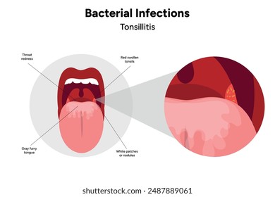 Medical diagram bacterial infections tonsillitis 
