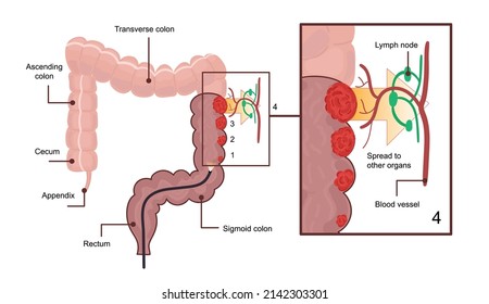 Medical diagram of colon cancer. scheme, anatomical illustration with 4 cancer stage and spreading to other organs.