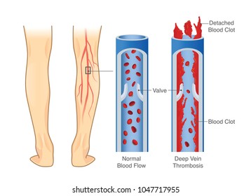 Medical Diagram Deep Vein Thrombosis Leg Stock Vector (Royalty Free ...