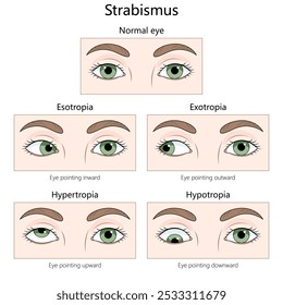 Diagrama médico diferentes tipos de estrabismo, esotropia, exotropia, hipertropia, hipotropia, olho normal para comparação ilustração de vetor desenhado à mão. Ilustração educacional de ciências médicas