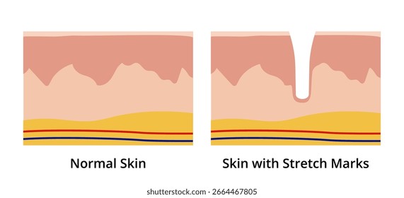 Diagrama médico que representa a diferença entre a pele normal e a pele afetada por estrias, mostrando a ruptura nas camadas da derme e da epiderme