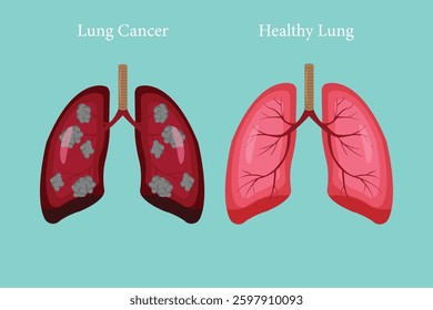 Medical diagram showing lung cancer versus healthy lung anatomy. eps 10