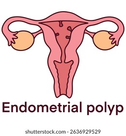 Medical diagram of uterus with endometrial polyp, a benign growth inside uterine lining. Used for gynecology, diagnostics, and reproductive education