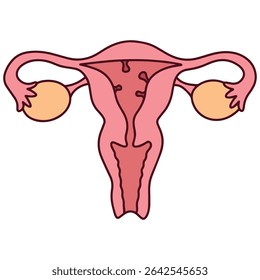 Diagrama médico do útero com pólipo endometrial, um crescimento benigno dentro do revestimento uterino. Usado para ginecologia, diagnóstico e educação reprodutiva