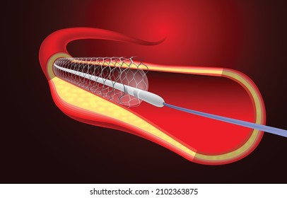 Medical And Educational Illustration Of Stent Implantation To Support Blood Flow Into The Blood Vessels.