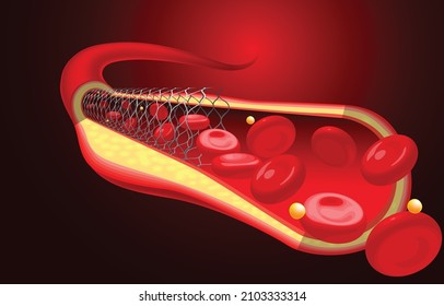 Medical And Educational Illustrations Of The Stent Are Already Inserted, Improving Blood Flow.