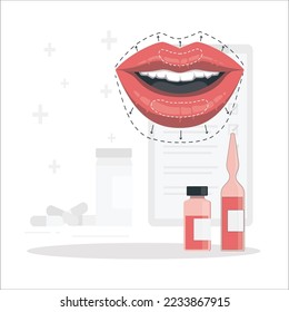 Medical glass bottles syringe lips implants infographic , lip fillers implants plastic syrgery. Lips injection, Lip Augmentation. injectable cosmetic filler. Vector illustration in cartoon style.