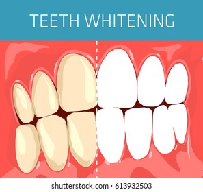 Medical and healthcare concept. Normal occlusion dental image. Teeth whitening visual scheme